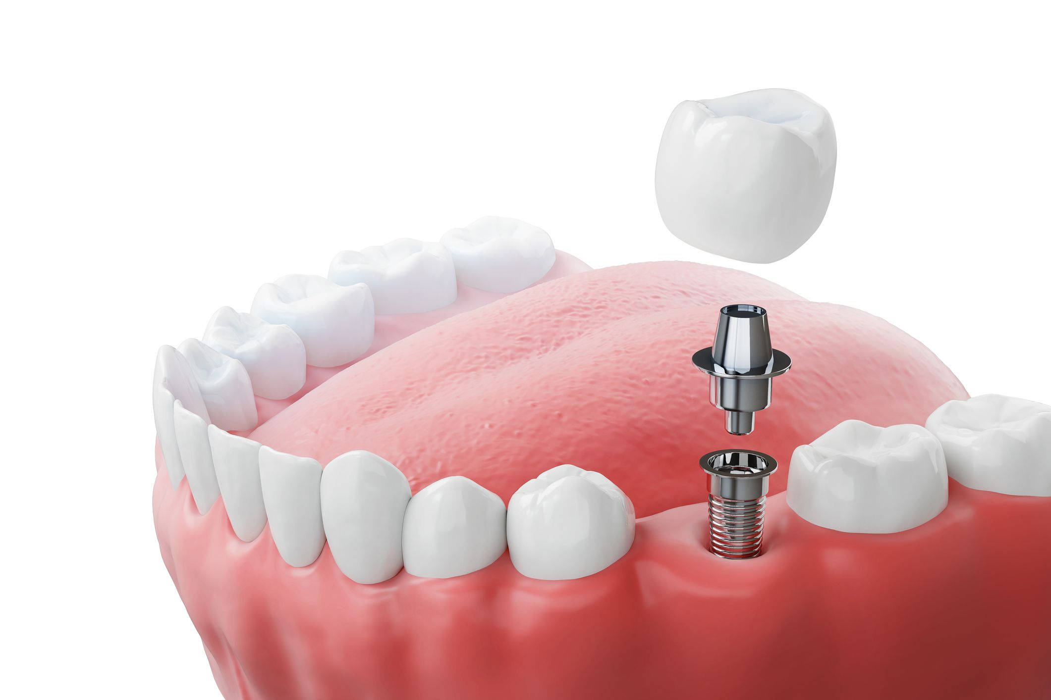 Implantes dentales en Chiclana de la Frontera. implantes en Chiclana, implantes de carga inmediata, prótesis sobre implantes.
