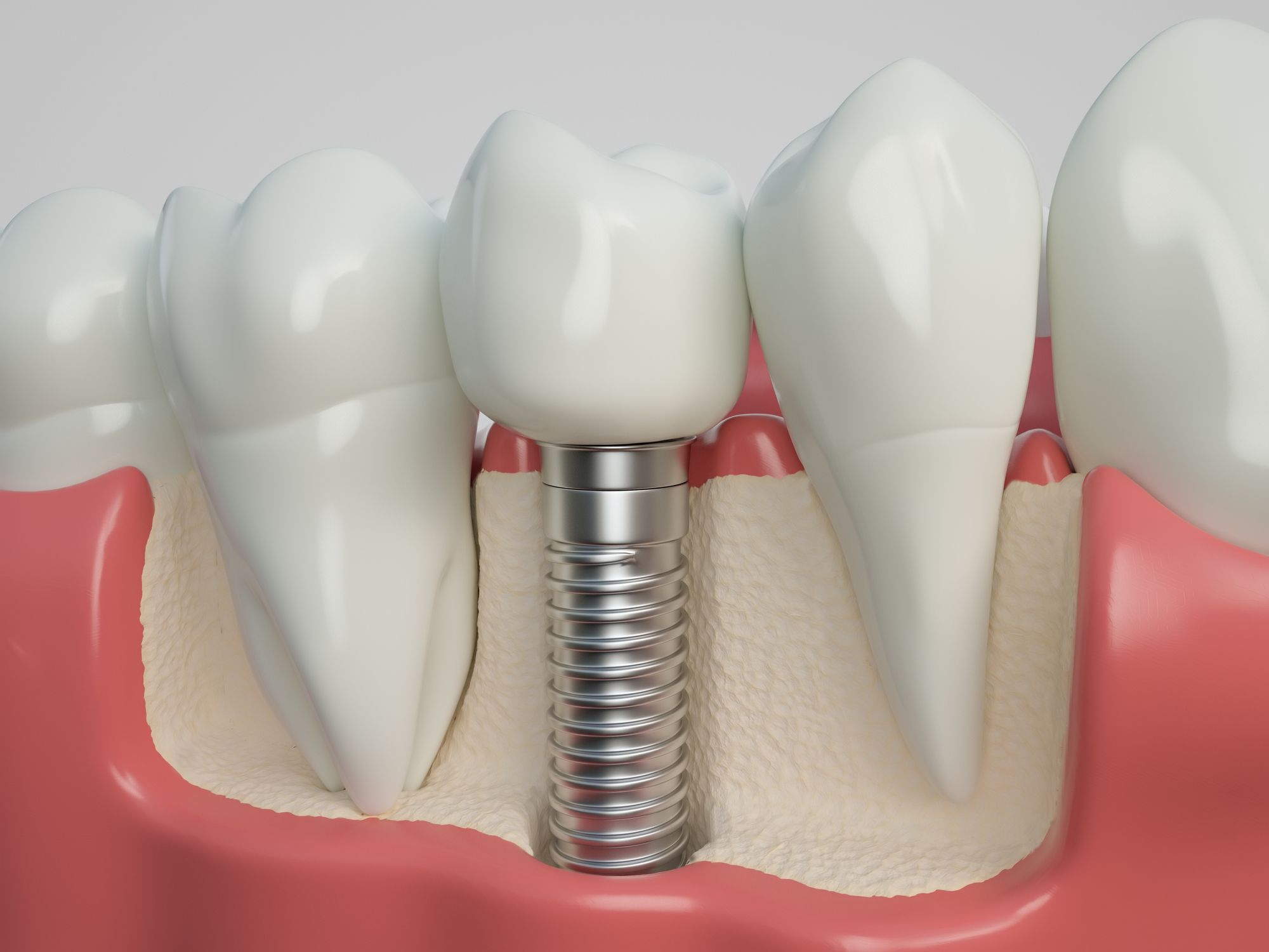 Implantes dentales en Chiclana de la Frontera. implantes en Chiclana, implantes de carga inmediata, prótesis sobre implantes.