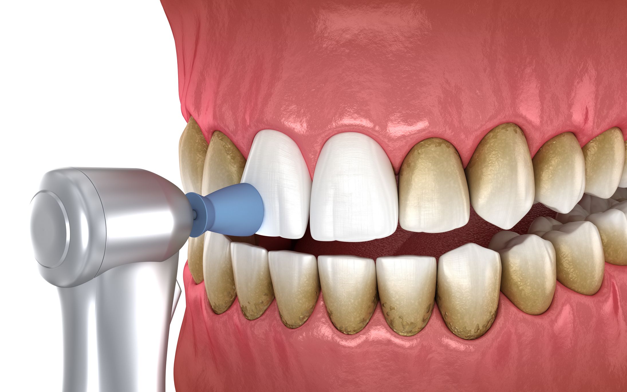 Odontología en Chiclana de la Frontera, tratamientos dentales en Chiclana de la Frontera.