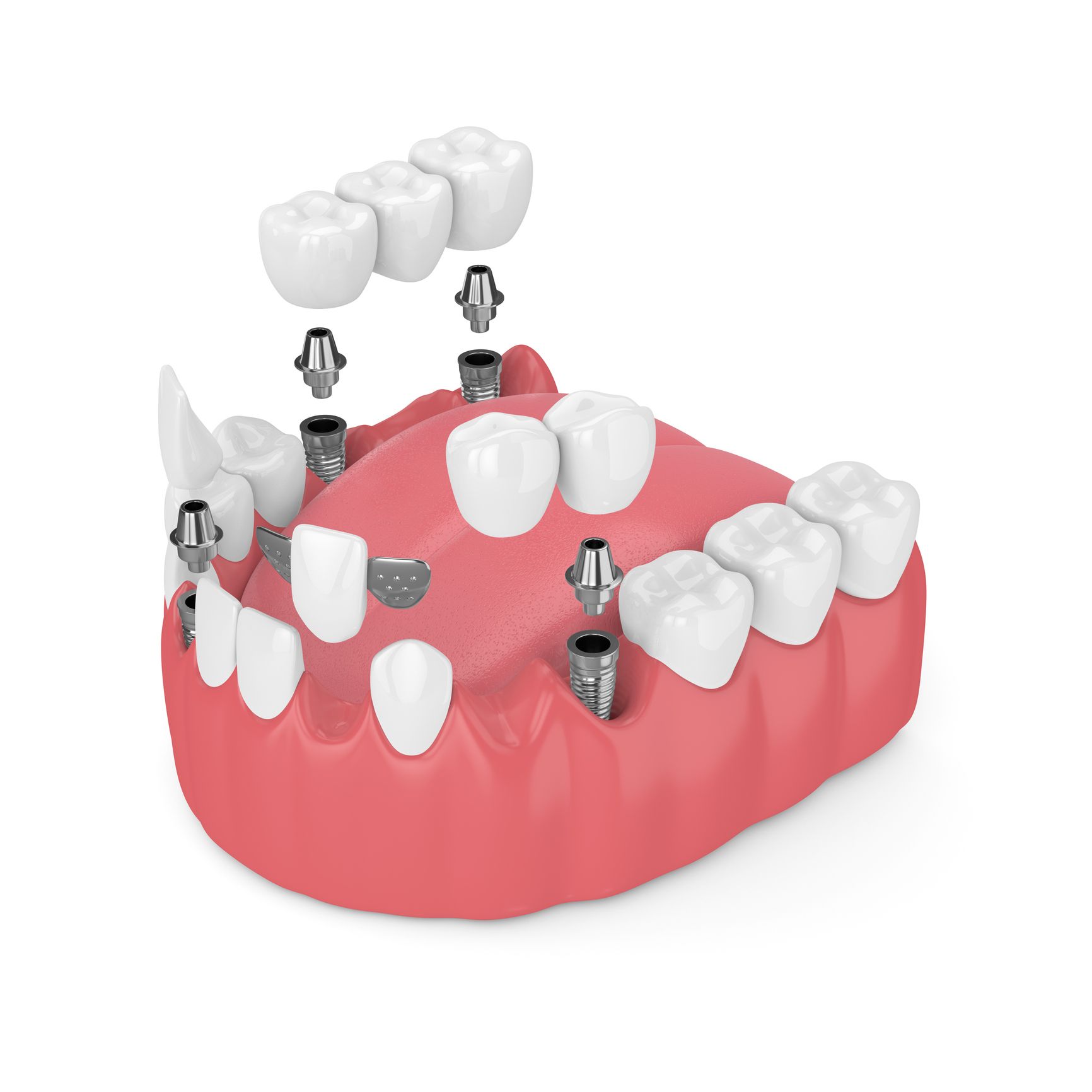 Prótesis dentales en Chiclana de la Frontera. prostodoncia en Chiclana, prótesis dentales removibles, prótesis dentosoportadas, prótesis implantosoportadas, prótesis sobre implantes.