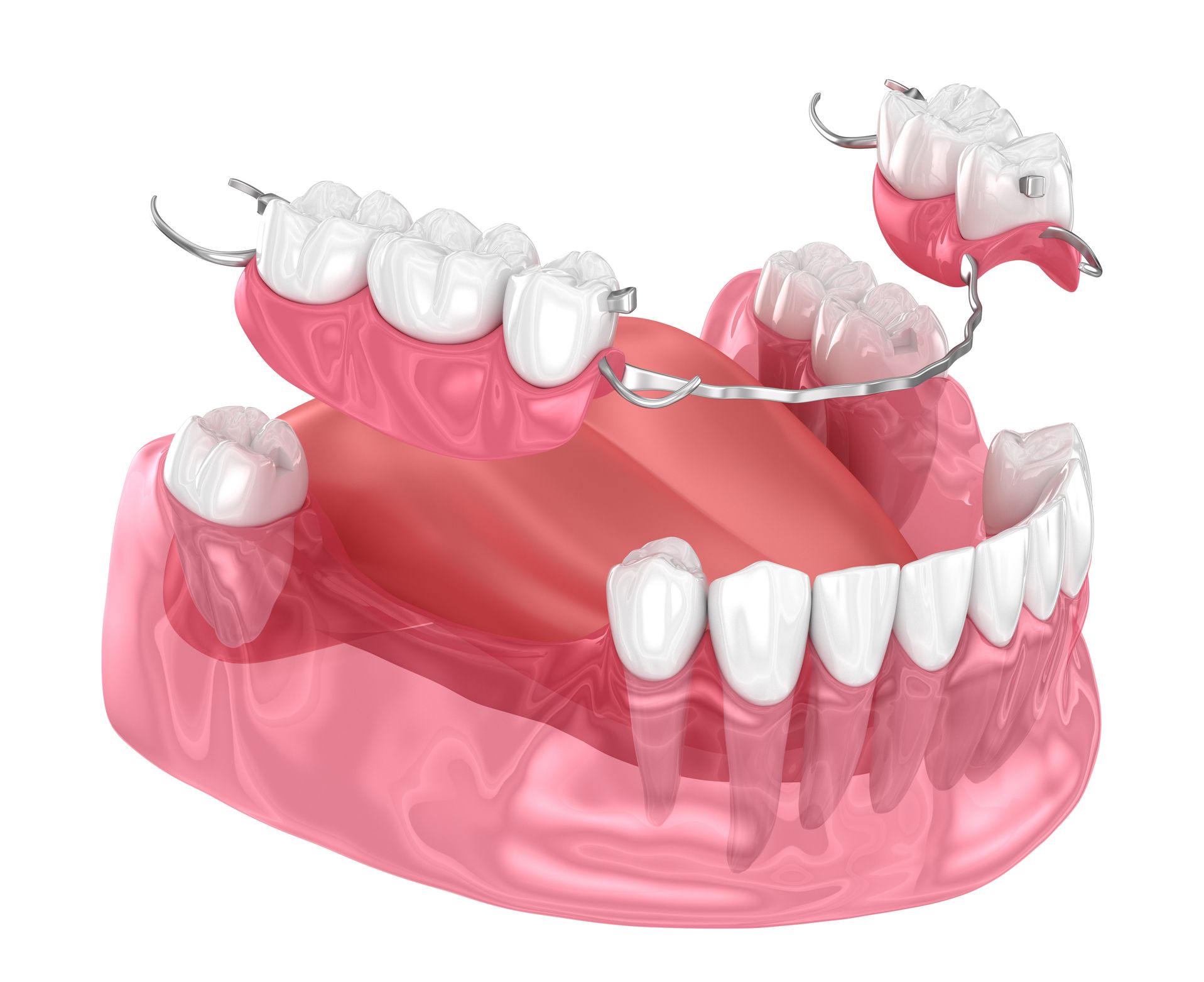 Prótesis dentales en Chiclana de la Frontera. prostodoncia en Chiclana, prótesis dentales removibles, prótesis dentosoportadas, prótesis implantosoportadas, prótesis sobre implantes.