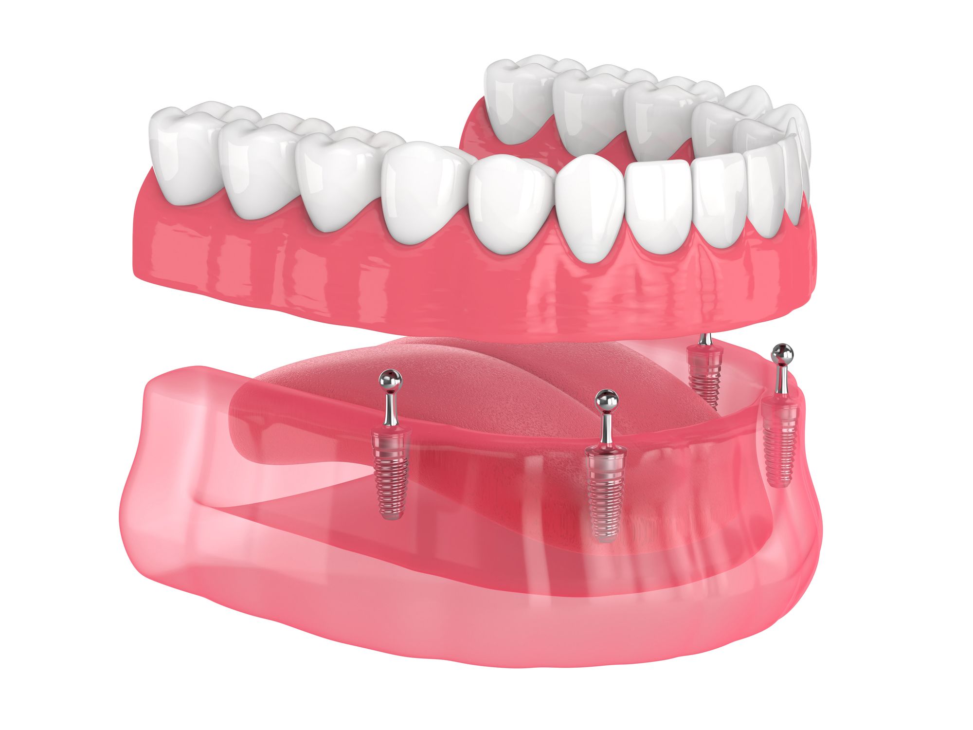 Prótesis dentales en Chiclana de la Frontera. prostodoncia en Chiclana, prótesis dentales removibles, prótesis dentosoportadas, prótesis implantosoportadas, prótesis sobre implantes.