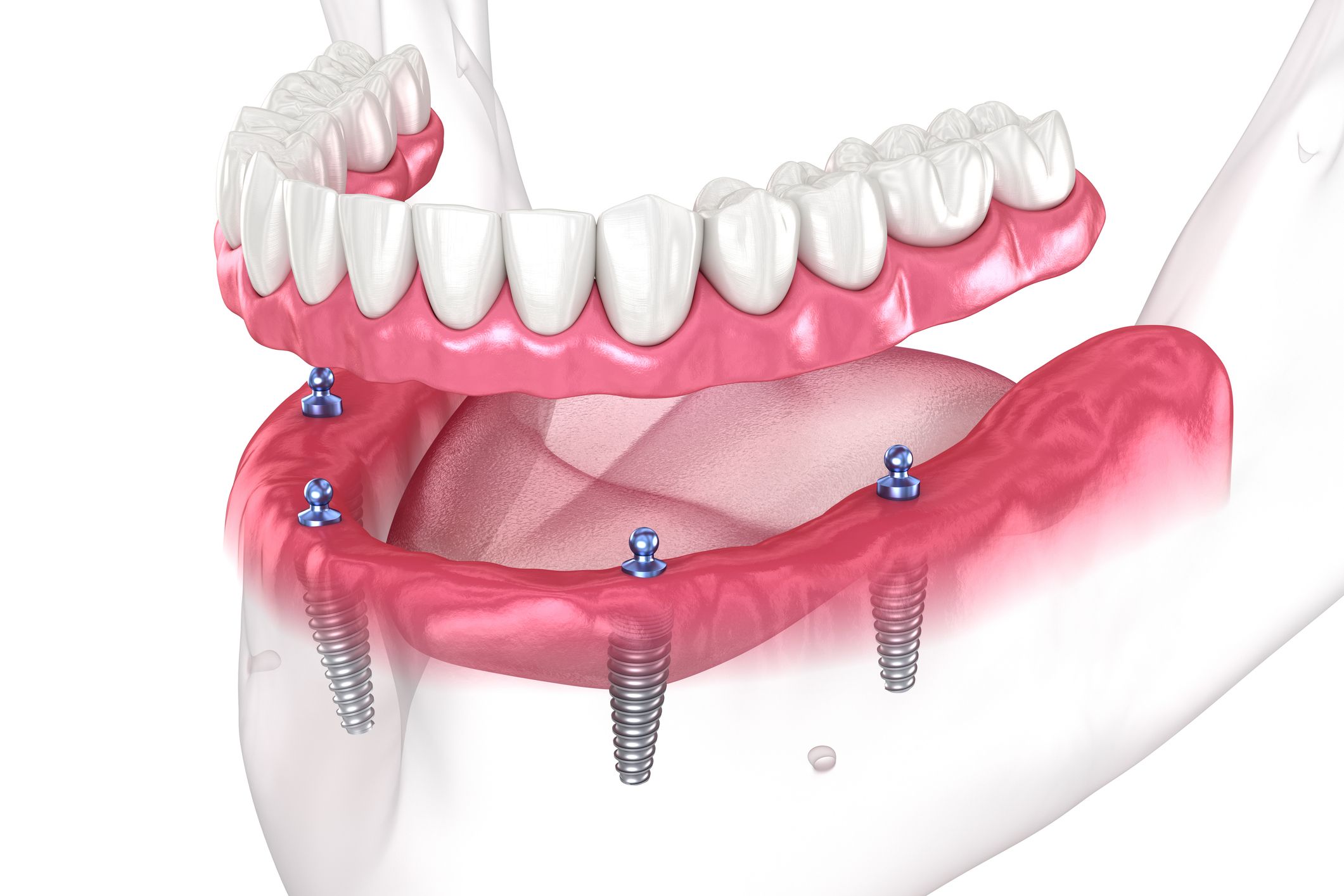 Implantes dentales en Chiclana de la Frontera. implantes en Chiclana, implantes de carga inmediata, prótesis sobre implantes.