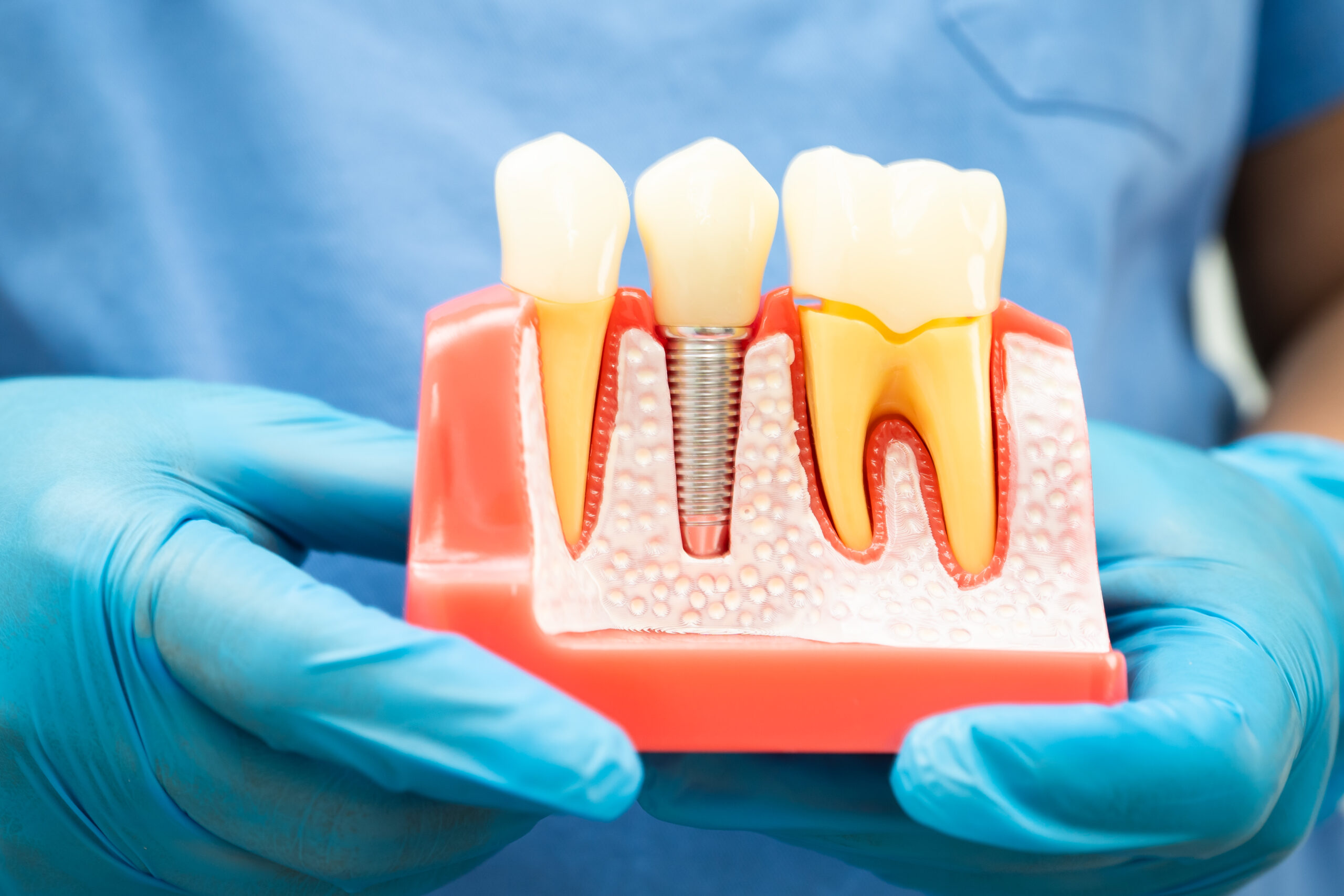 implantes dentales en chiclana de la frontera