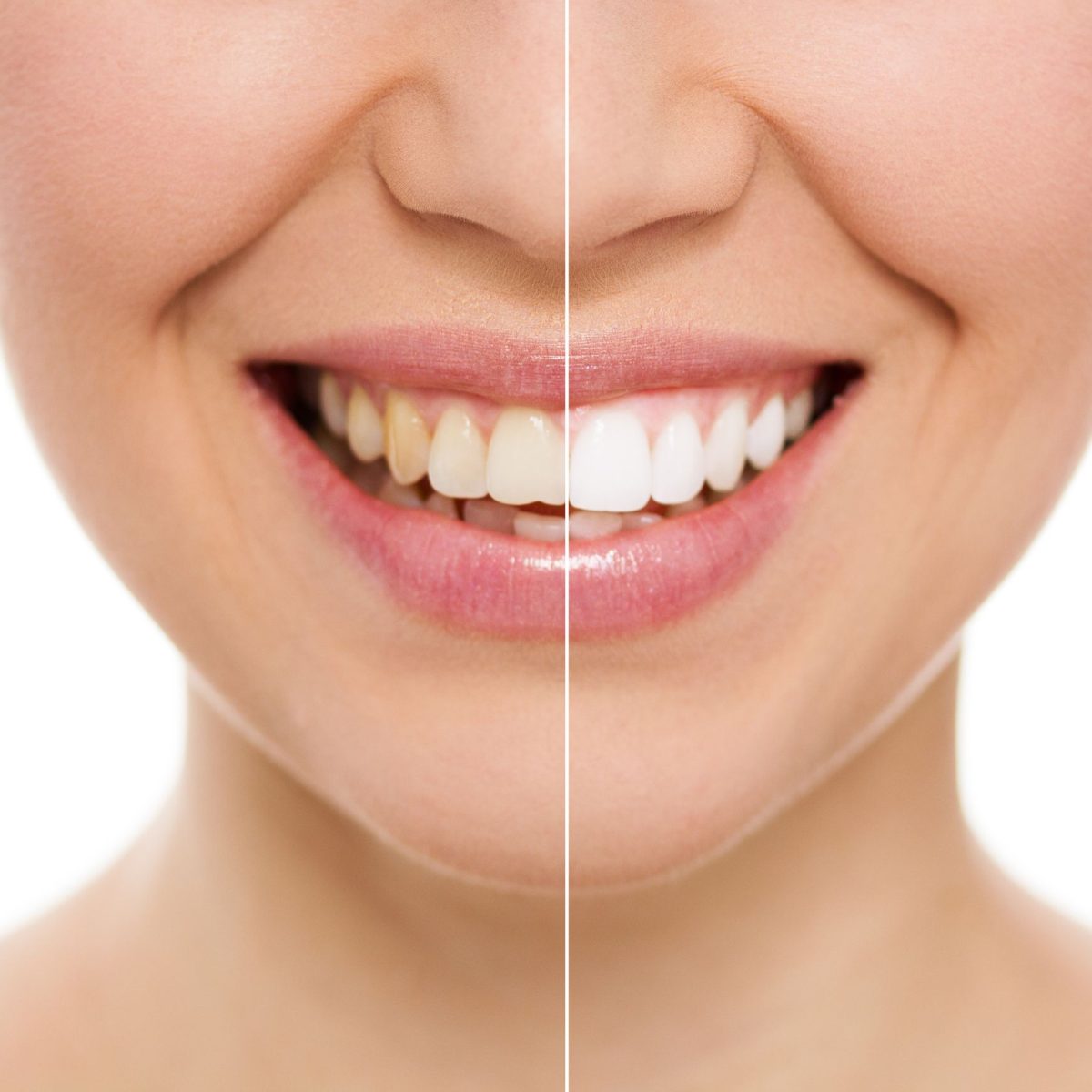 Estética dental en Chiclana de la Frontera. Blanqueamiento dental en Chiclana, carillas dentales en Chiclana, carillas de composite, carillas de laboratorio, blanqueamiento en casa, blanqueamiento en clínica.