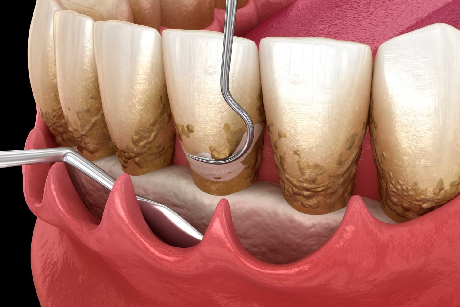 Periodoncia en Chiclana de la Frontera, tratamiento para las encías en Chiclana.
