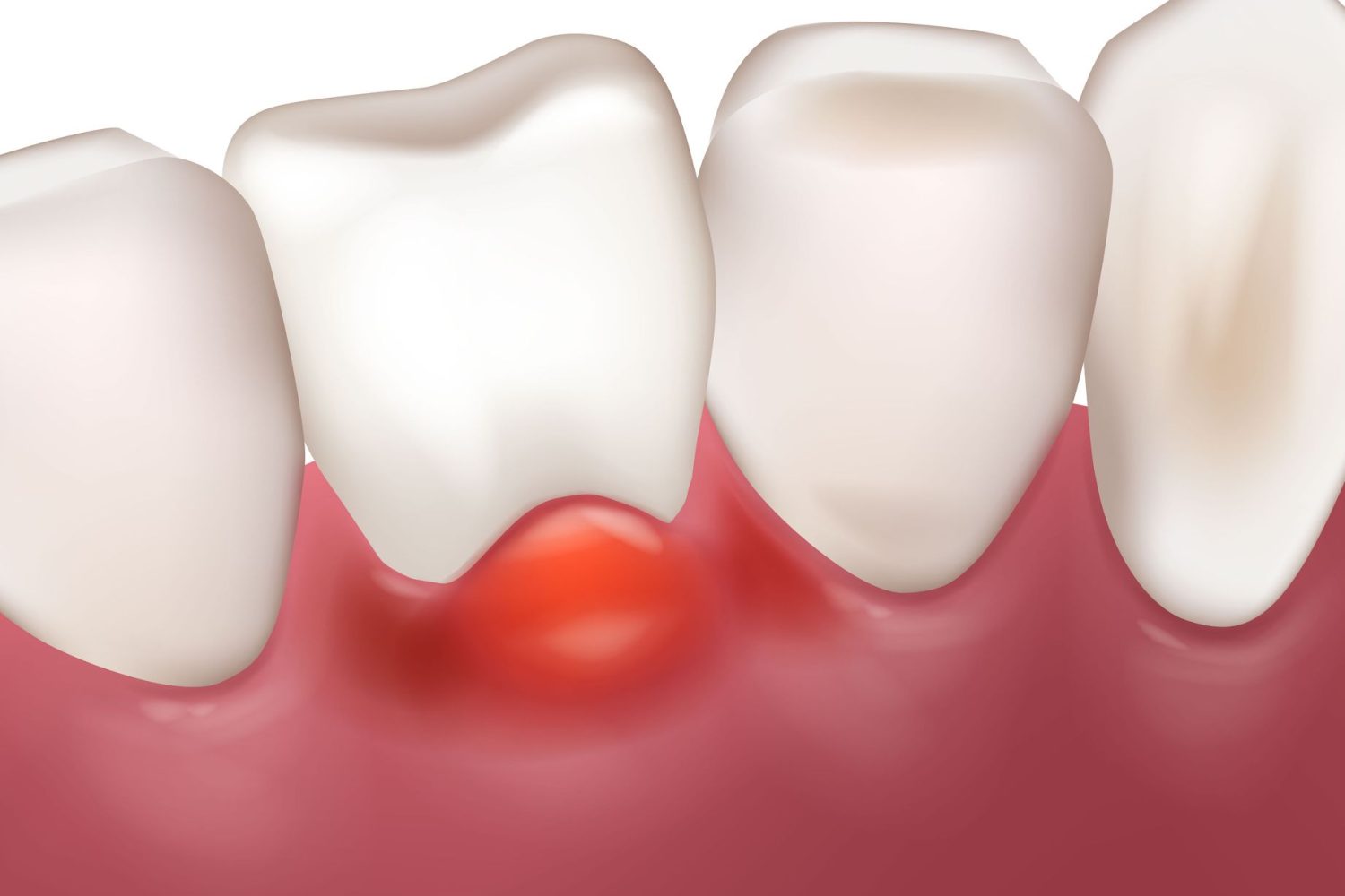 Cirugía oral en Chiclana de la Frontera. cirugía dental en Chiclana, cirugía bucodental en Chiclana.