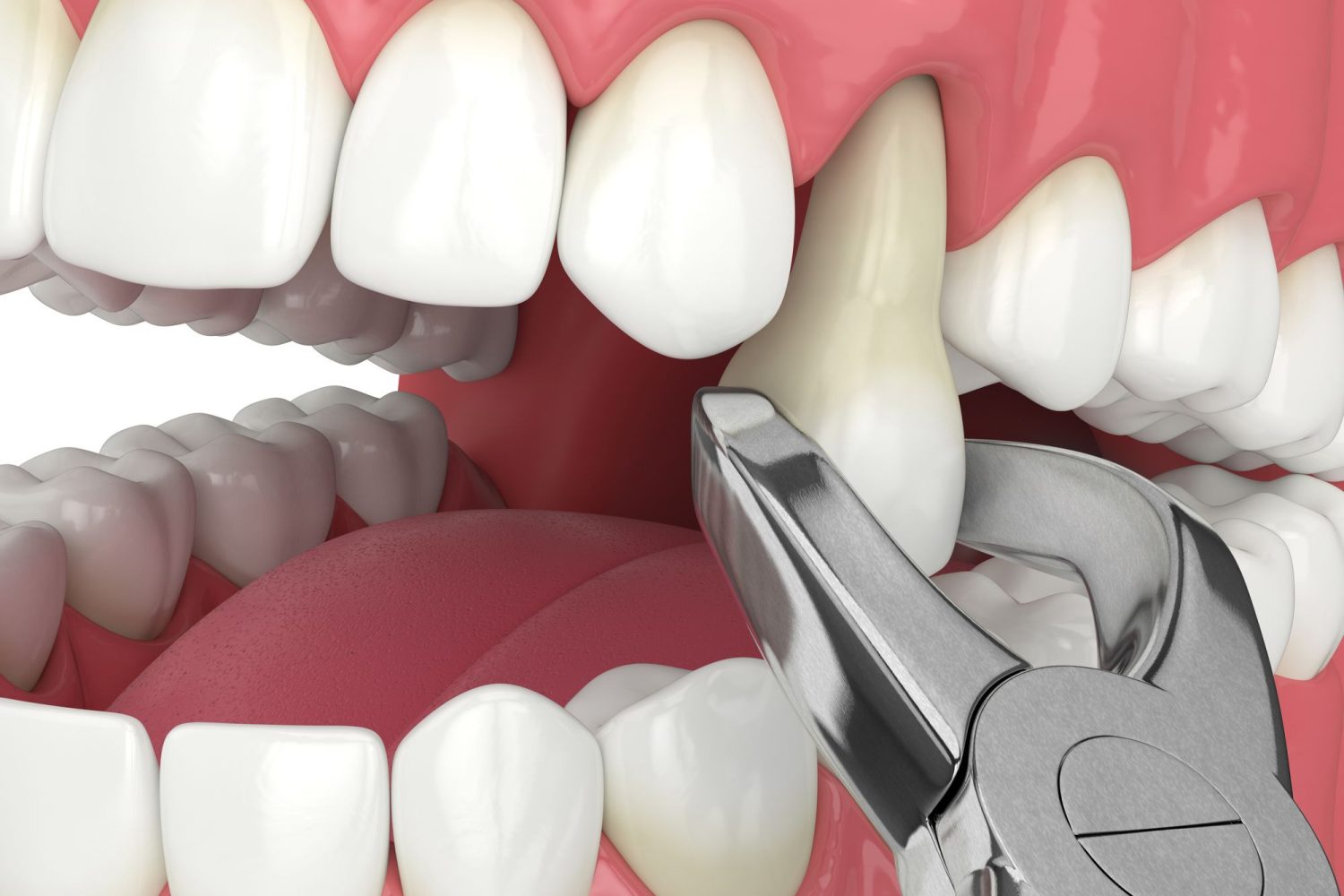 Cirugía oral en Chiclana de la Frontera. cirugía dental en Chiclana, cirugía bucodental en Chiclana.