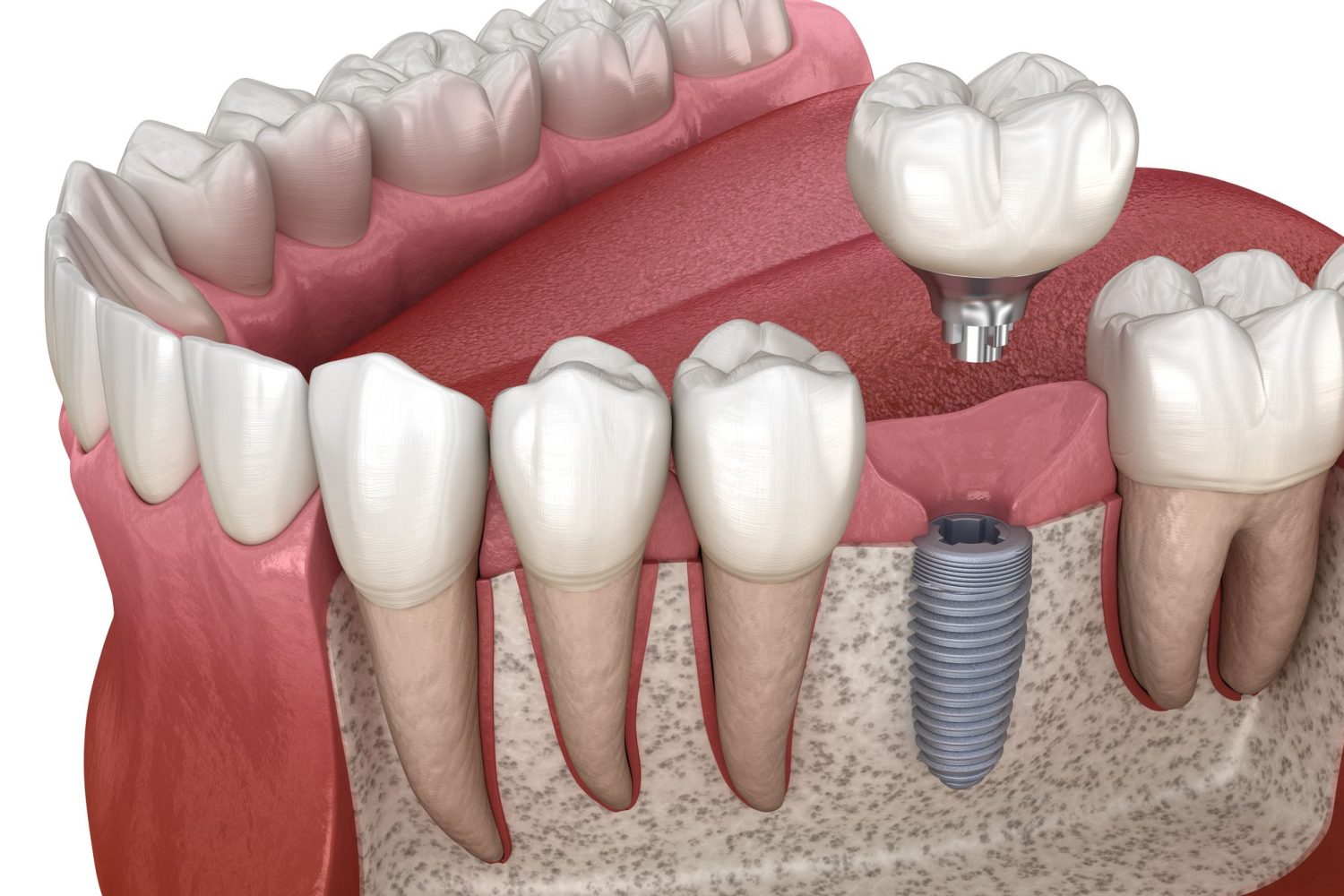 Cirugía oral en Chiclana de la Frontera. cirugía dental en Chiclana, cirugía bucodental en Chiclana.