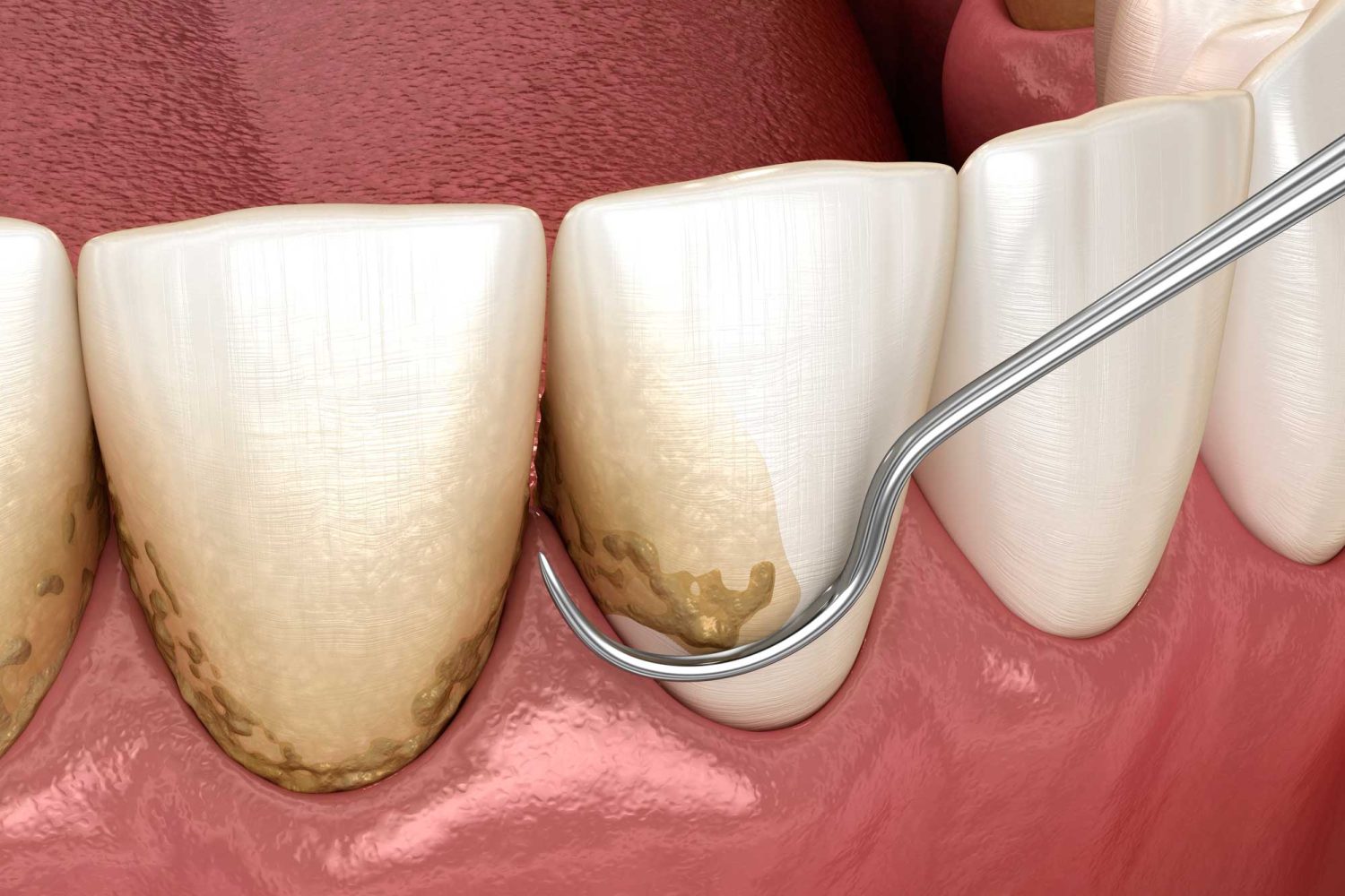 Periodoncia en Chiclana de la Frontera, tratamiento para las encías en Chiclana.